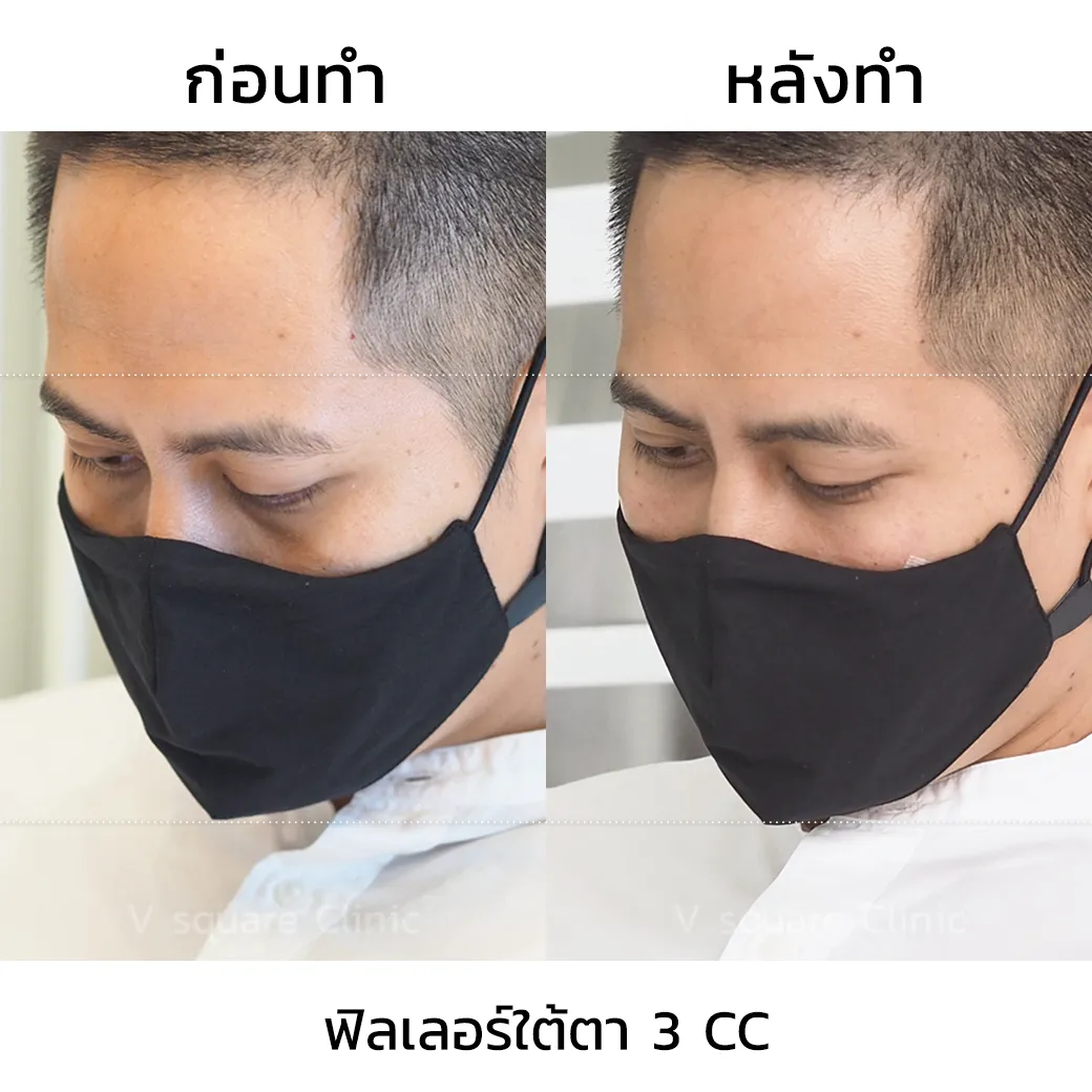 รีวิวฟิลเลอร์ใต้ตา-2-cc-2 คุณไผ่