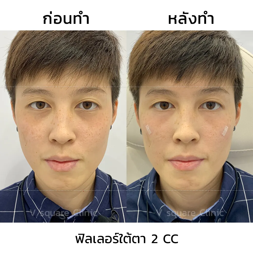 รีวิวฟิลเลอร์ใต้ตา-2-cc-3 พลอยน้อย