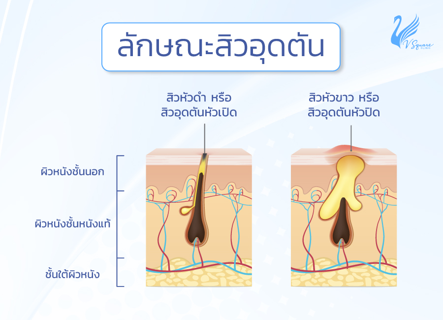 ลักษณะสิวอุดตัน