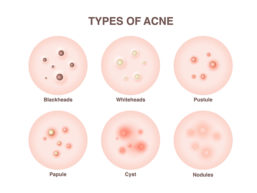สิวอักเสบ สาเหตุเกิดจากอะไร มีกี่แบบ ดูแล-ป้องกัน และรักษาวิธีไหนได้บ้าง ? สิวอักเสบ สาเหตุเกิดจากอะไร มีกี่แบบ ดูแล-ป้องกัน และรักษาวิธีไหนได้บ้าง ?