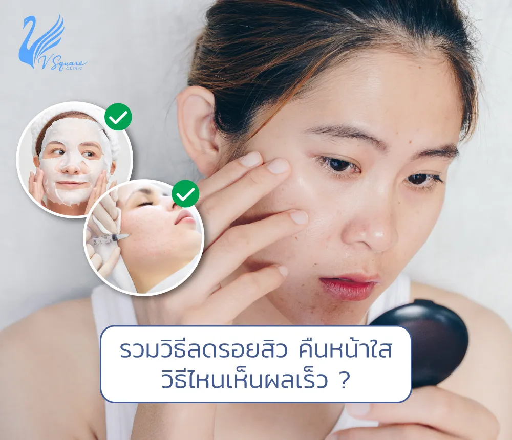 10 วิธีลดรอยสิว รอยแดง ให้หน้าใส แต่ละวิธีเห็นผลมากแค่ไหน วิธีไหนเห็นผลเร็ว