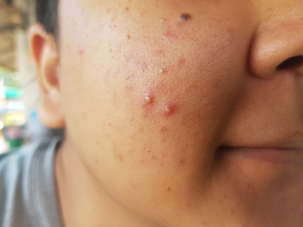 สิวอักเสบ สาเหตุเกิดจากอะไร มีกี่แบบ ดูแล-ป้องกัน และรักษาวิธีไหนได้บ้าง ?