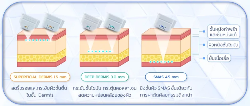 การทำงาน Ulthera SPT