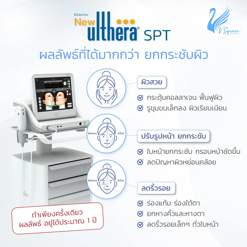 จุดที่ทำ Ulthera SPT