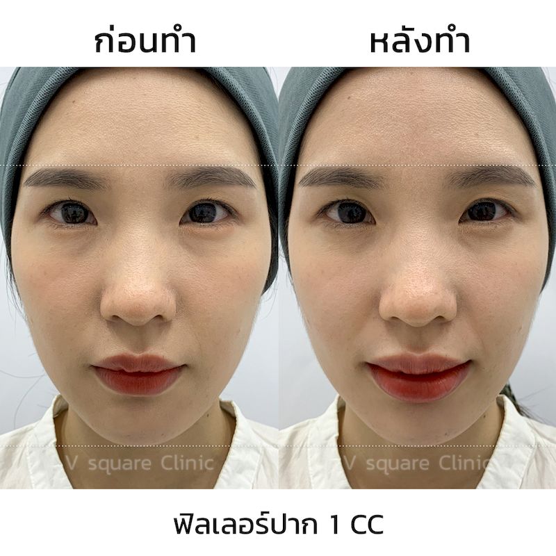 รีวิว ฟิลเลอร์ปรับทรงปาก 1 CC