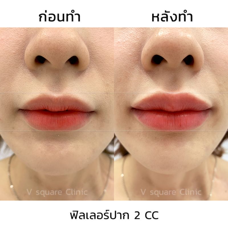 รีวิว ฟิลเลอร์ปรับทรงปาก 2 CC