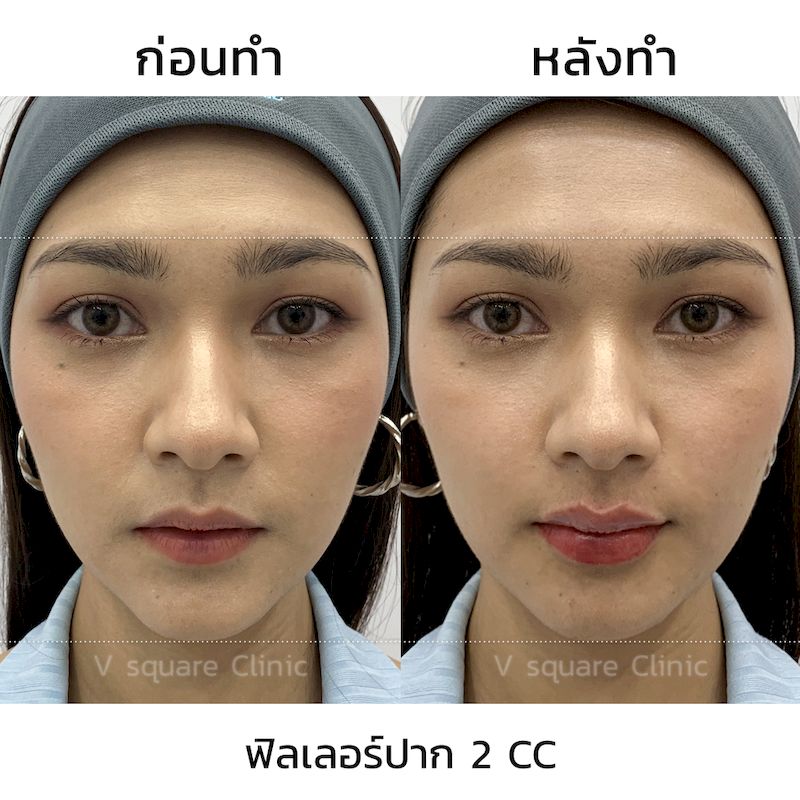 รีวิว ฟิลเลอร์ปรับทรงปาก 2 CC