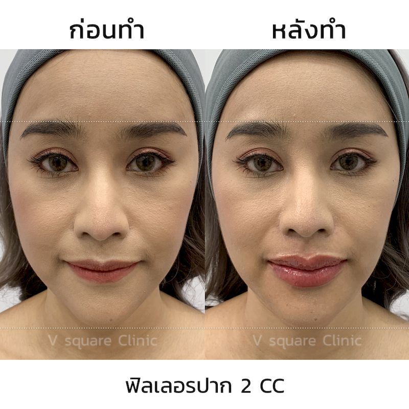 รีวิว ฟิลเลอร์ปรับทรงปาก 2 CC