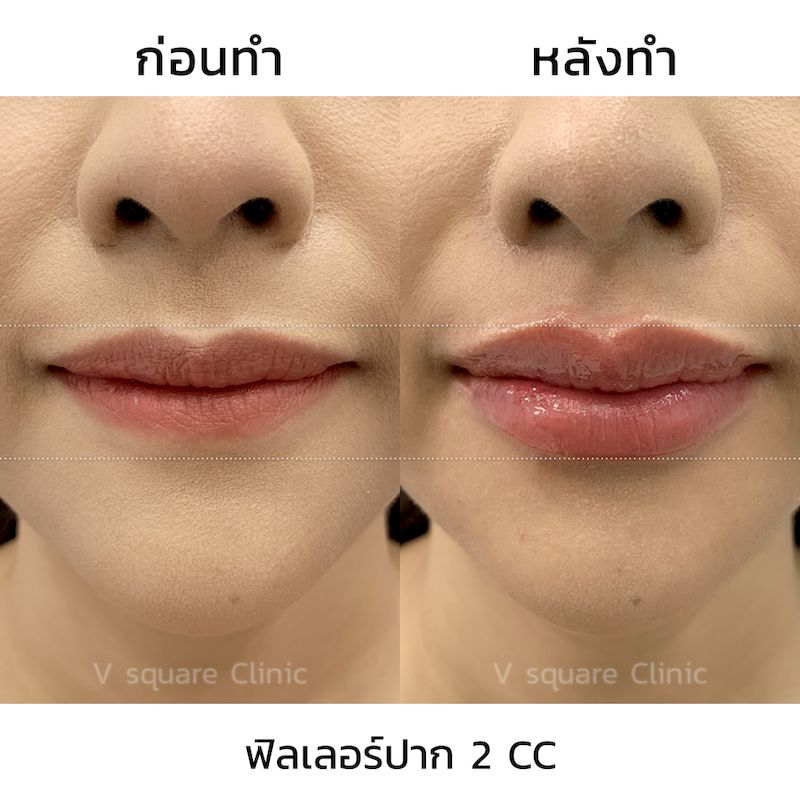 รีวิว ฟิลเลอร์ปรับทรงปาก 2 CC