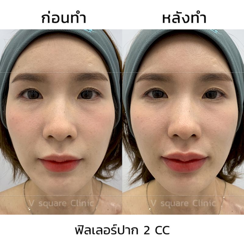 รีวิว ฟิลเลอร์ปรับทรงปาก 2 CC