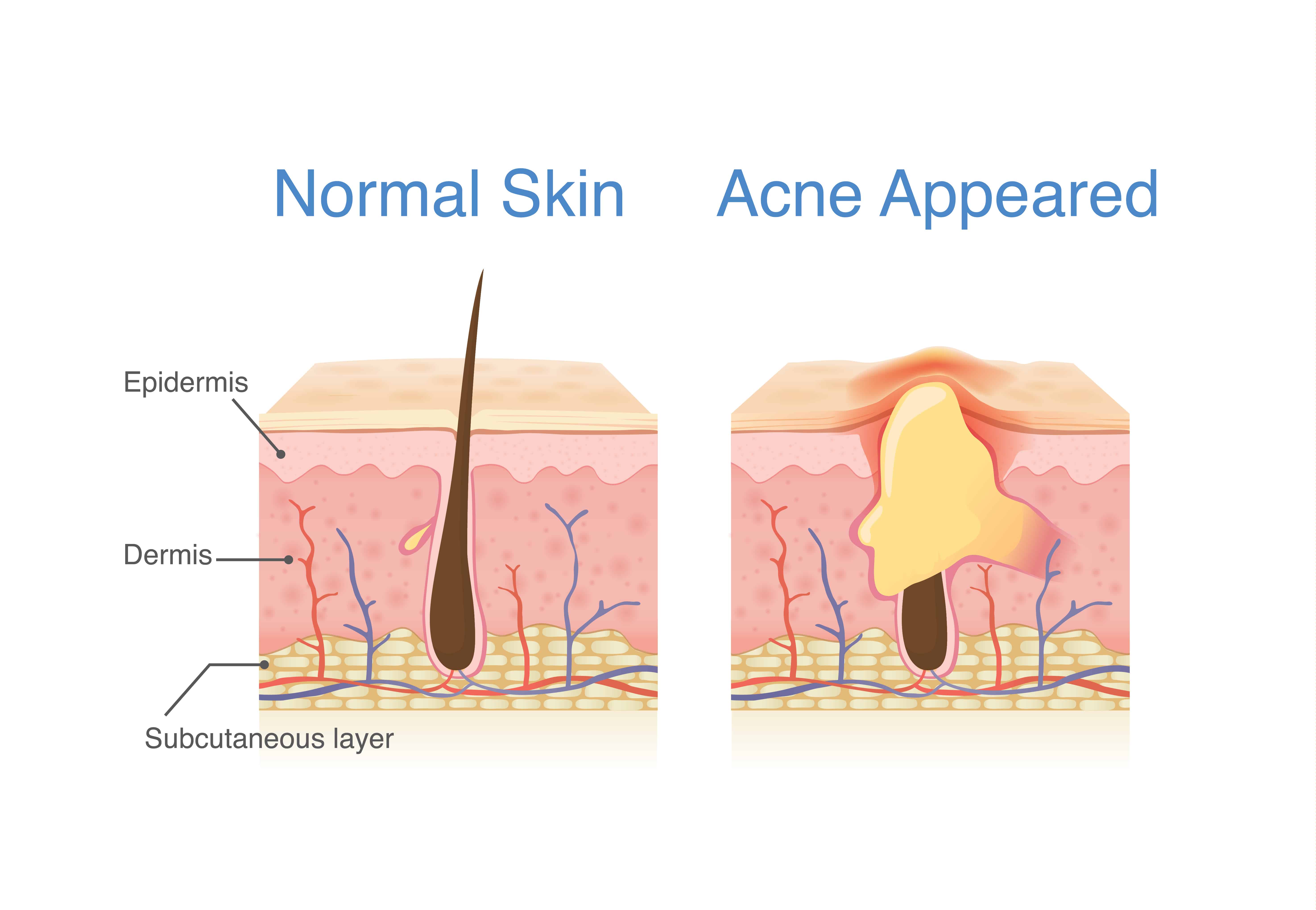 สาเหตุสิวอักเสบ