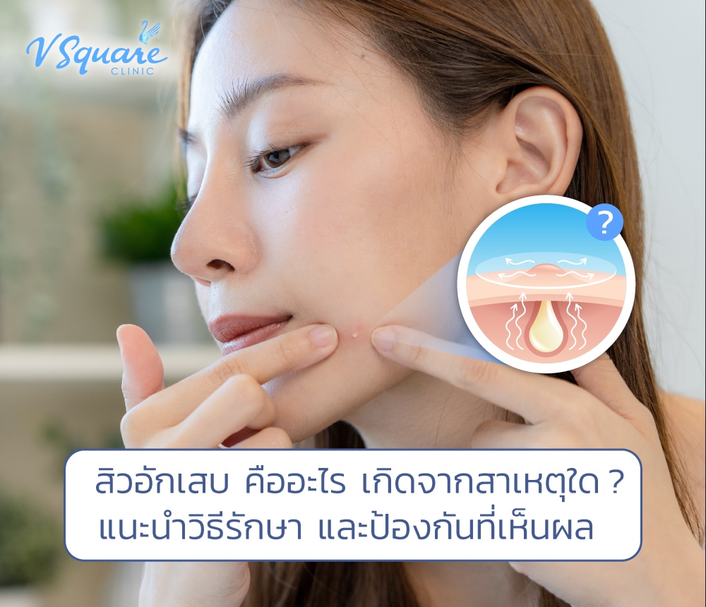 สิวอักเสบ