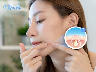 สิวอักเสบ 370x277