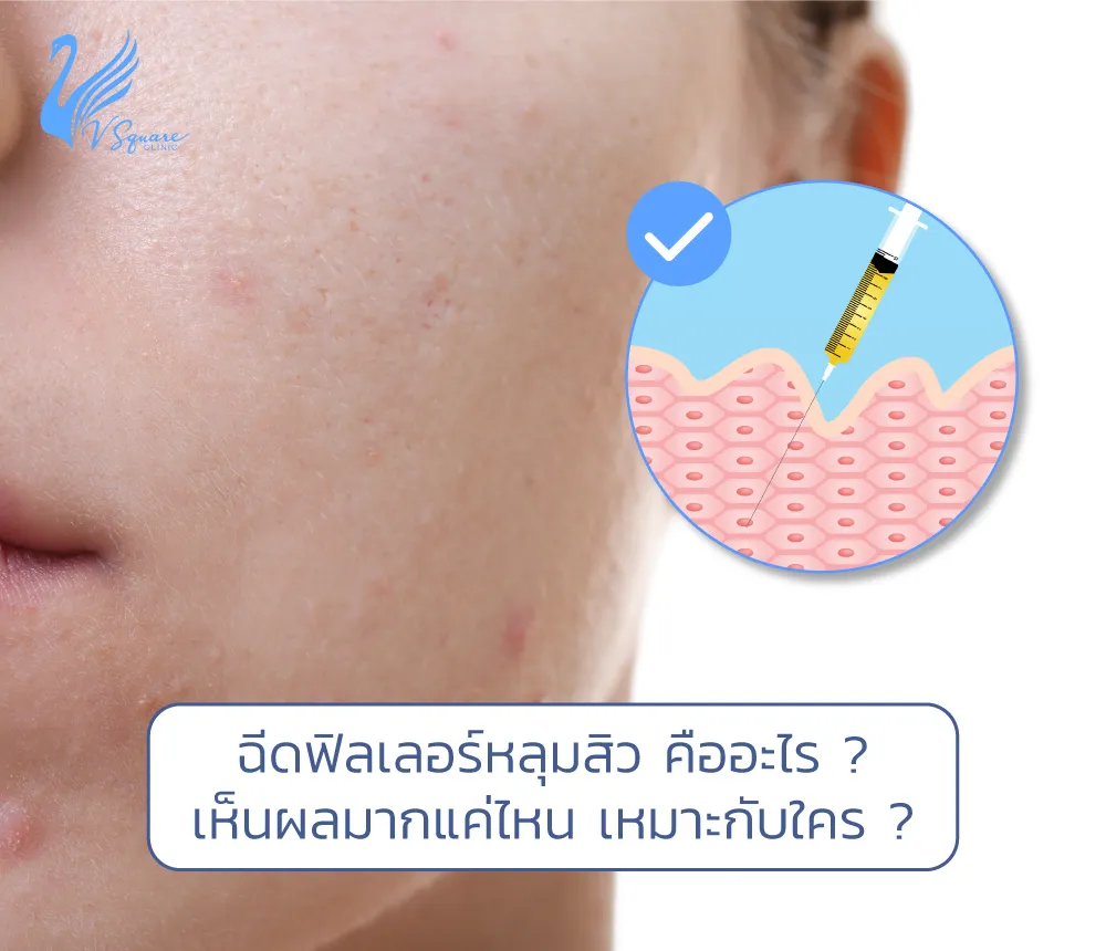 ฉีดฟิลเลอร์หลุมสิว รักษาหลุมสิวได้อย่างไร เหมาะกับใครบ้าง ต้องทำกี่ครั้ง ฉีดฟิลเลอร์หลุมสิว รักษาหลุมสิวได้อย่างไร เหมาะกับใครบ้าง ต้องทำกี่ครั้ง