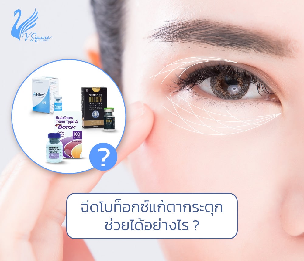 ฉีดโบท็อกแก้ตากระตุก ช่วยรักษาได้อย่างไร เจ็บไหม มีข้อดีอย่างไร ? ฉีดโบท็อกแก้ตากระตุก ช่วยรักษาได้อย่างไร เจ็บไหม มีข้อดีอย่างไร ?