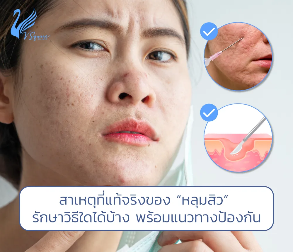 หลุมสิวมีกี่แบบ รักษาวิธีไหนดี รู้สาเหตุและวิธีป้องกันเพื่อใบหน้าเรียบเนียน