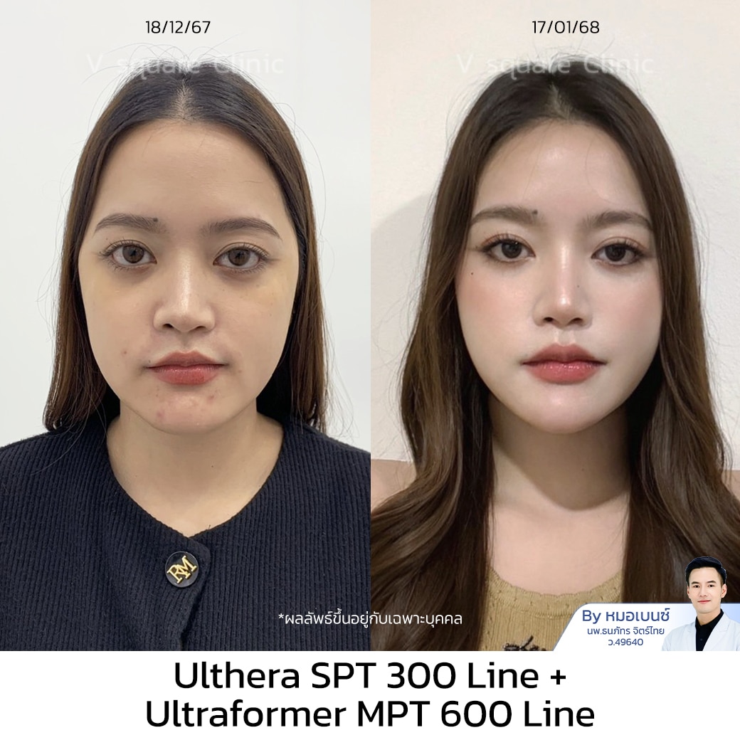 Ulthera รอบดวงตา_คุณเฟรนด์ UL SPT+MPT
