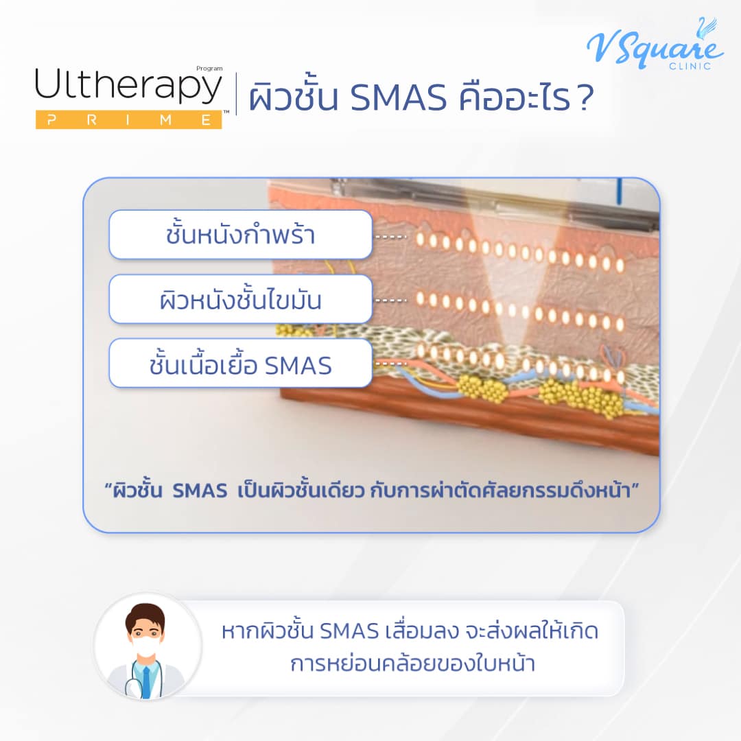ulthera ส่งพลังงานลึกถึงชั้น SMAS