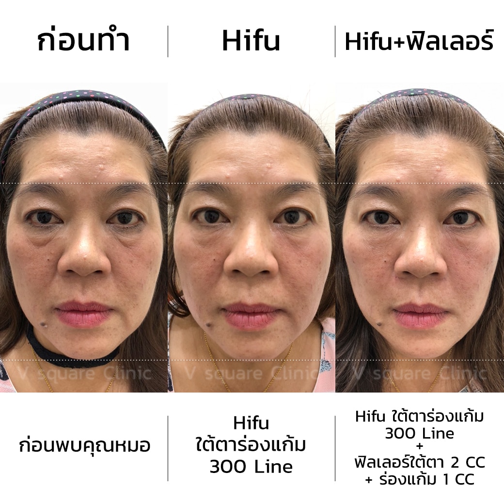 รีวิวผลการรักษา Hifu ใต้ตา ร่องแก้ม 300 line