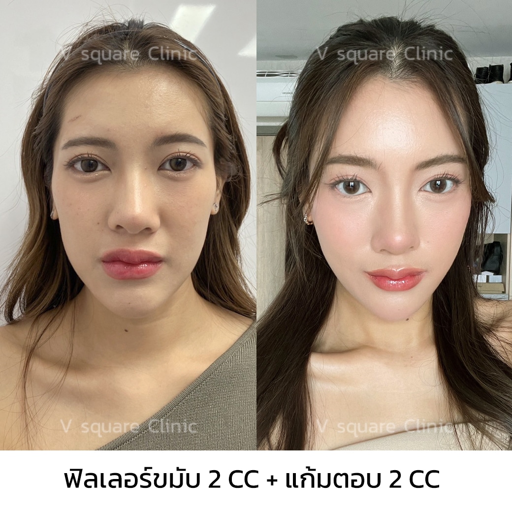 รีวิวฟิลเลอร์ Neuramis_คุณจูนิสา อินฟลู