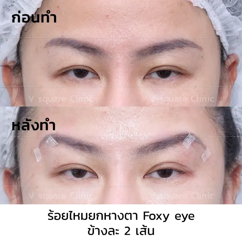 ร้อยไหม Foxy eye1