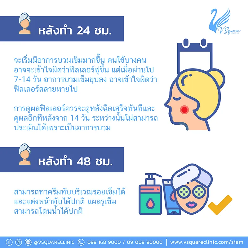 หลังฉีดฟิลเลอร์หลุมสิว1