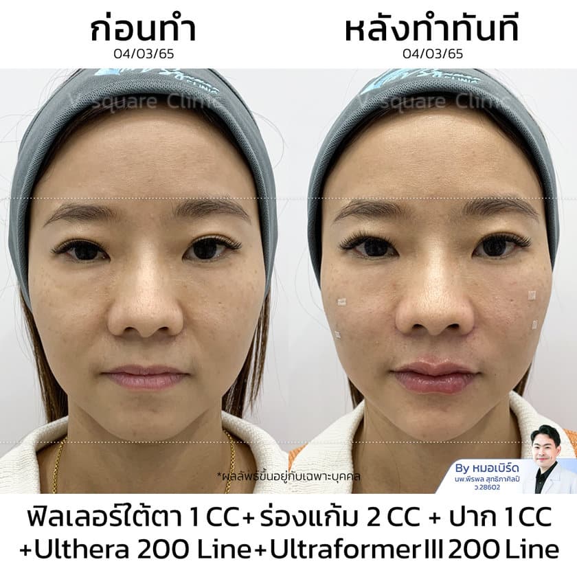 รีวิว Ulthera 200 line