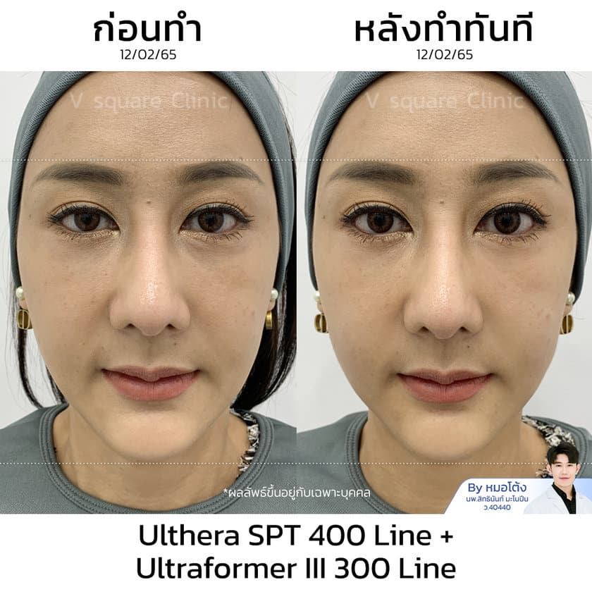 รีวิว Ulthera 300 line