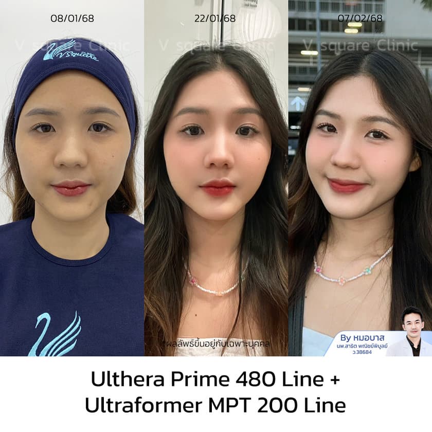 รีวิว Ulthera เอิร์น UL RR+MPT