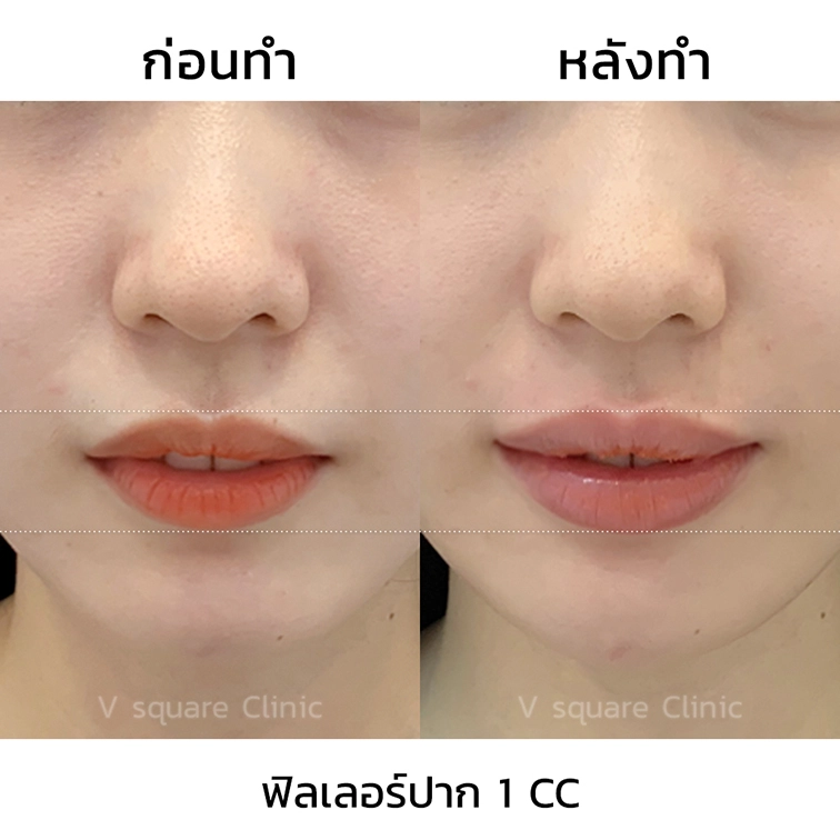 รีวิว ฉีดปากกระจับ 1 cc