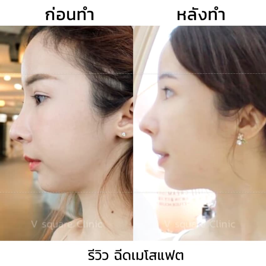 รีวิว เมโสแฟตเหนียง