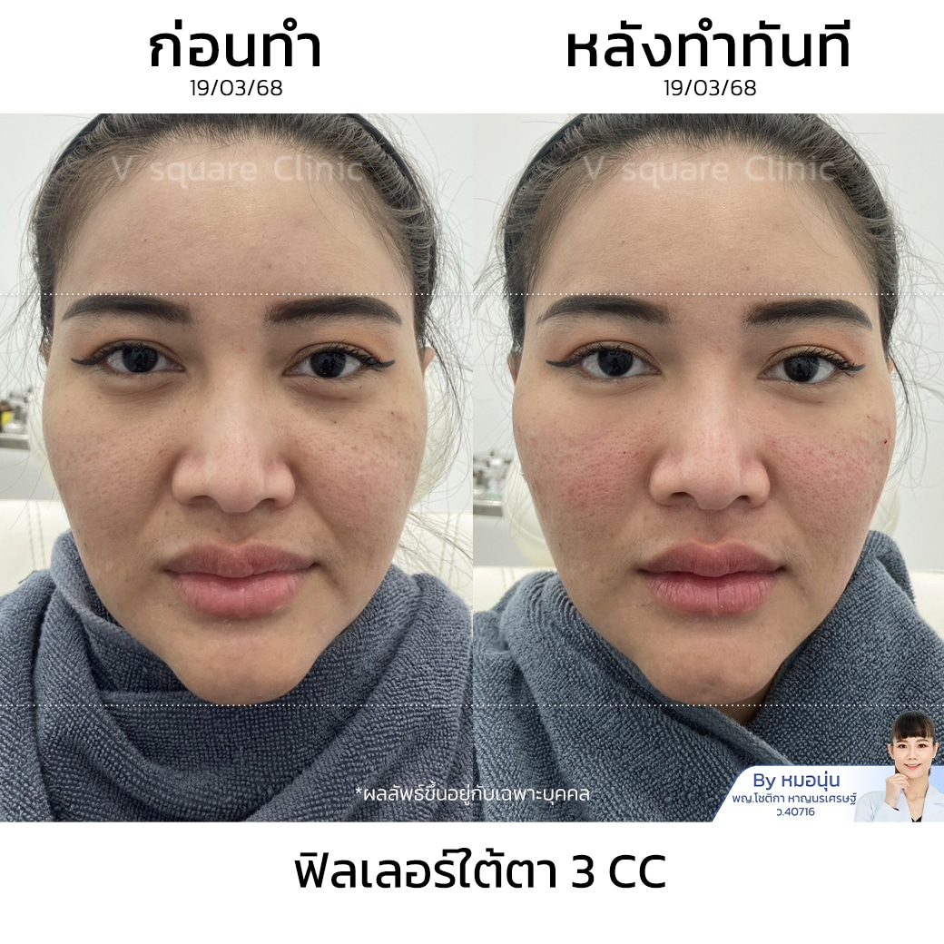รีวิวฉีดฟิลเลอร์ใต้ตา