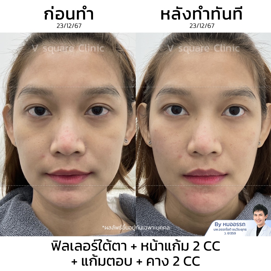 รีวิวฉีด ฟิลเลอร์ใต้ตา