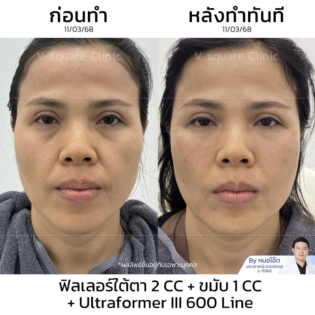 รีวิว ฉีดฟิลเลอร์ใต้ตา
