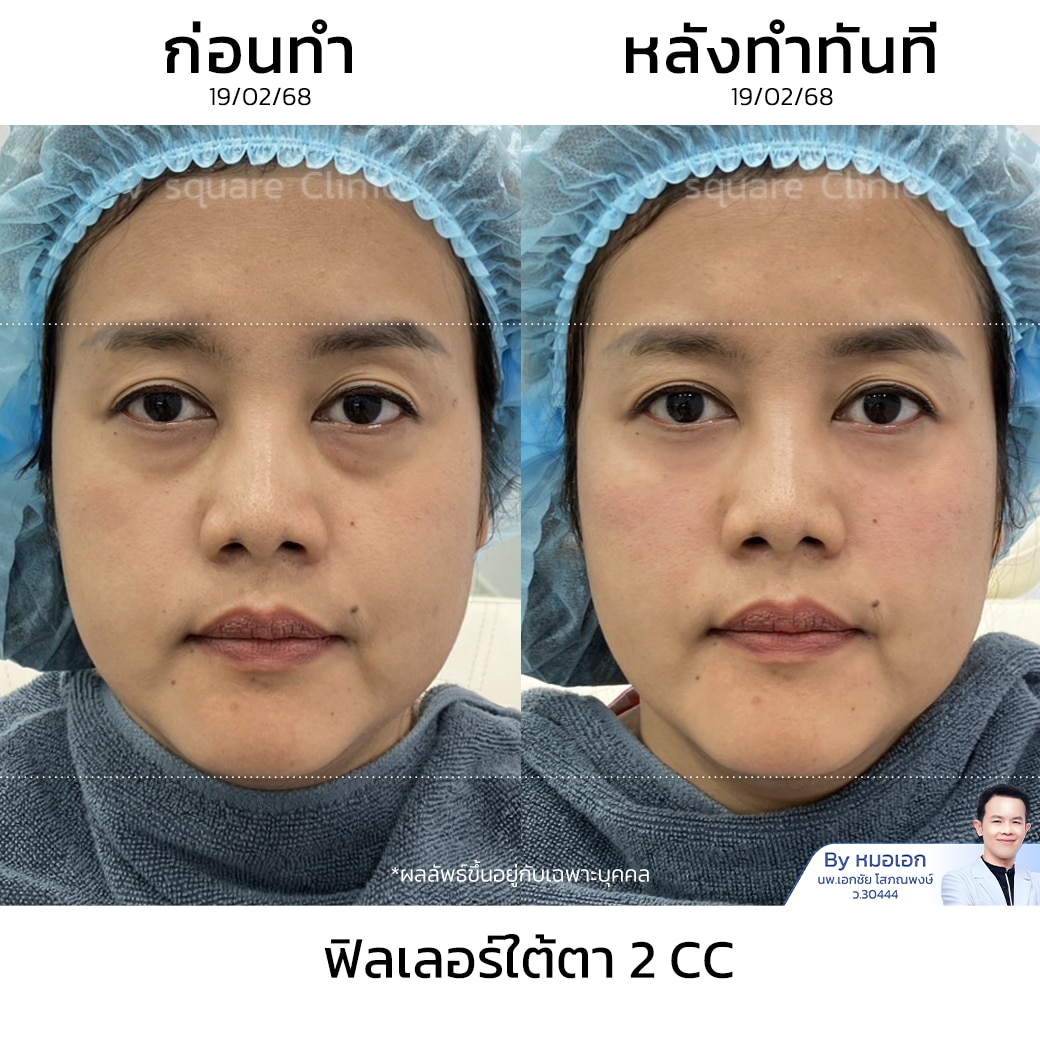 รีวิวฉีดฟิลเลอร์ ใต้ตา