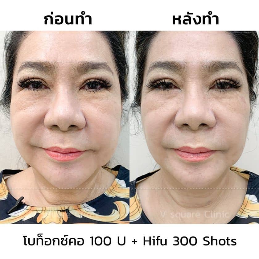 รีวิวฉีดโบท็อกคอ