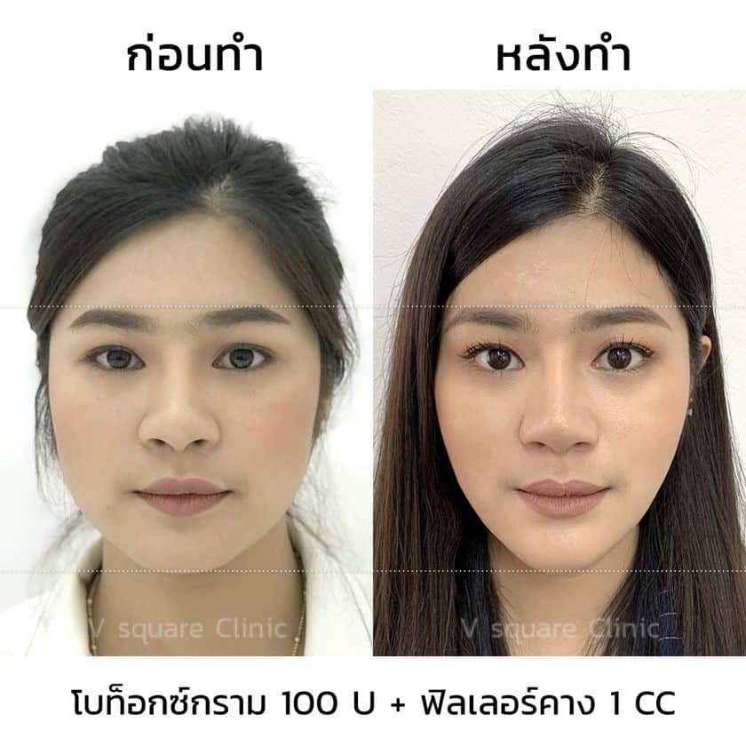 รีวิวฉีดโบท็อกลดกรามหน้าเรียว