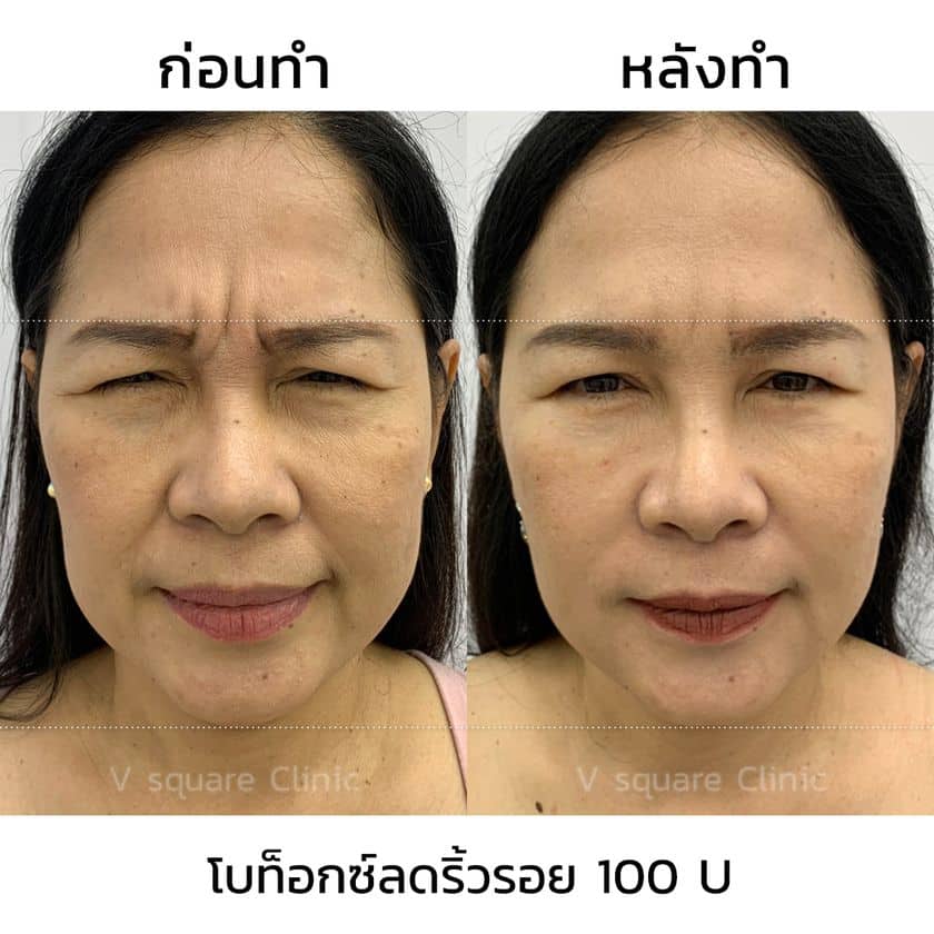 รีวิวฉีดโบท็อกลดริ้วรอย