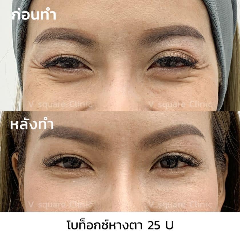 รีวิวฉีดโบท็อกหางตา