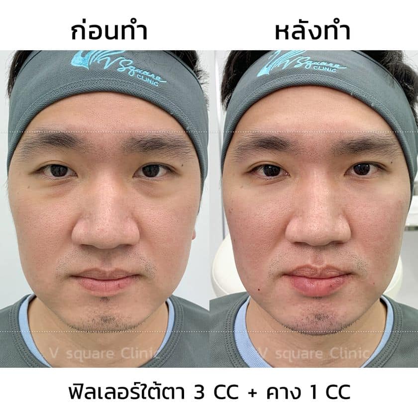 รีวิวฟิลเลอร์ใต้ตา