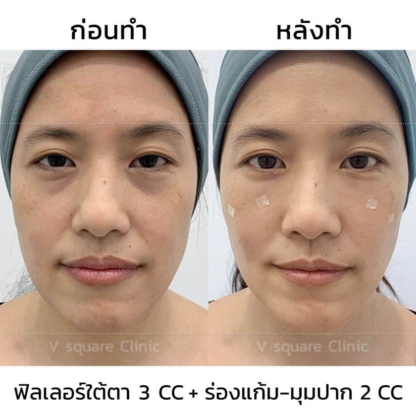 รีวิวฟิลเลอร์ใต้ตา