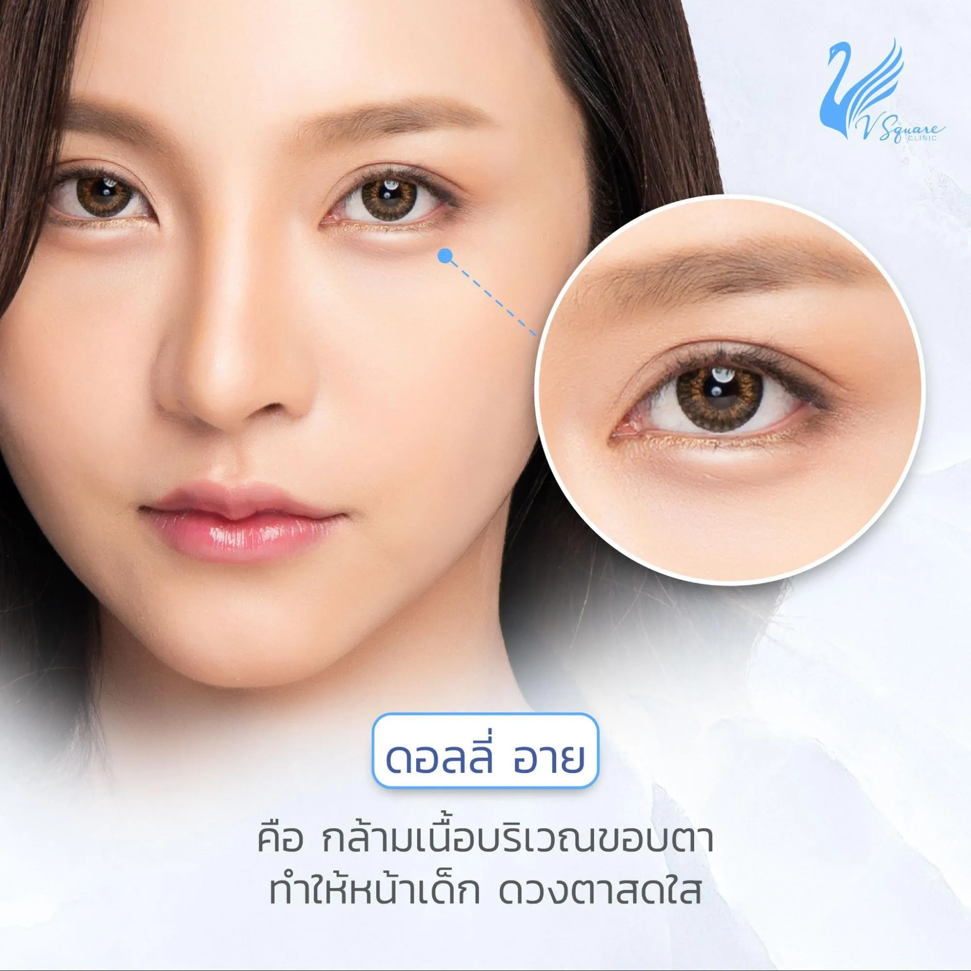 ตาไม่เท่ากัน เกิดจากอะไร ? รวมวิธีแก้ไขชั้นตาให้เท่ากันโดยไม่ต้องผ่าตัด