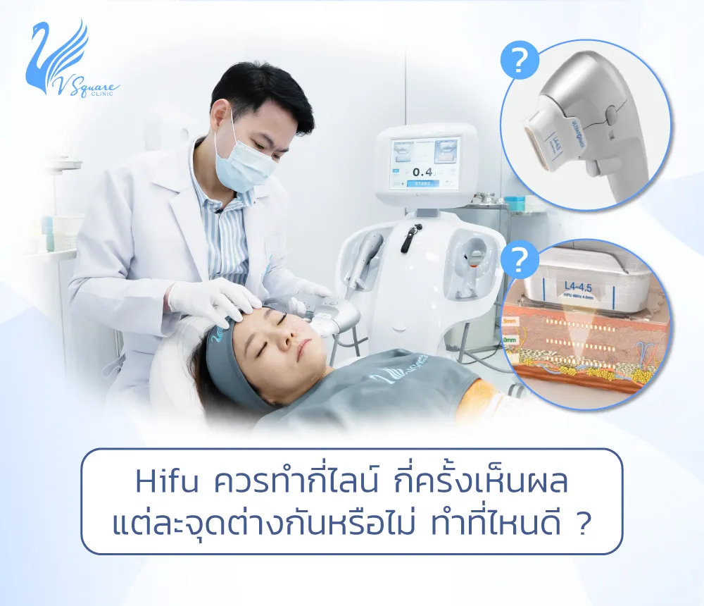 Hifu-ควรทำกี่ไลน์-กี่ครั้งเห็นผล1000x860