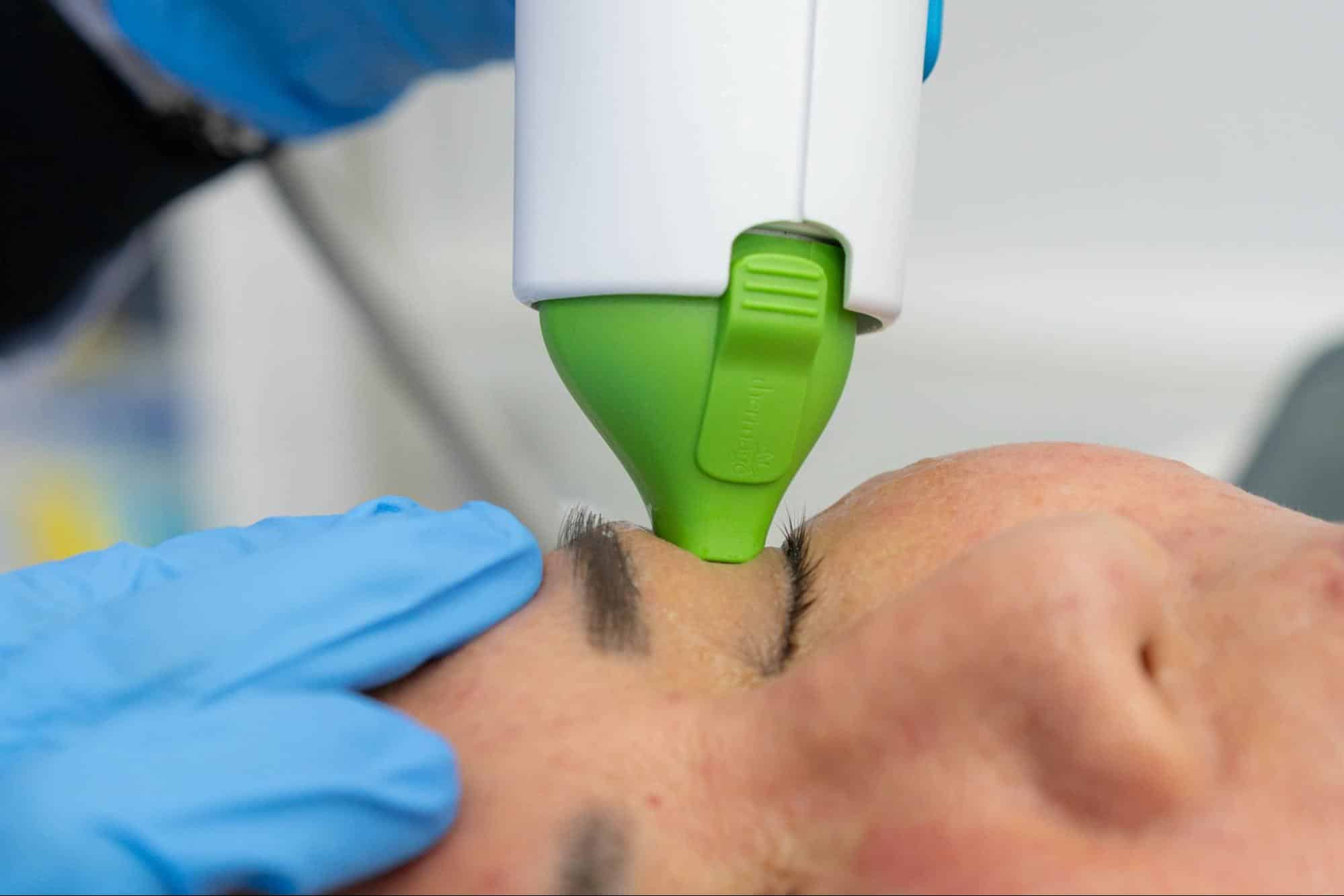 Thermage ชั้นตาไม่เท่ากัน