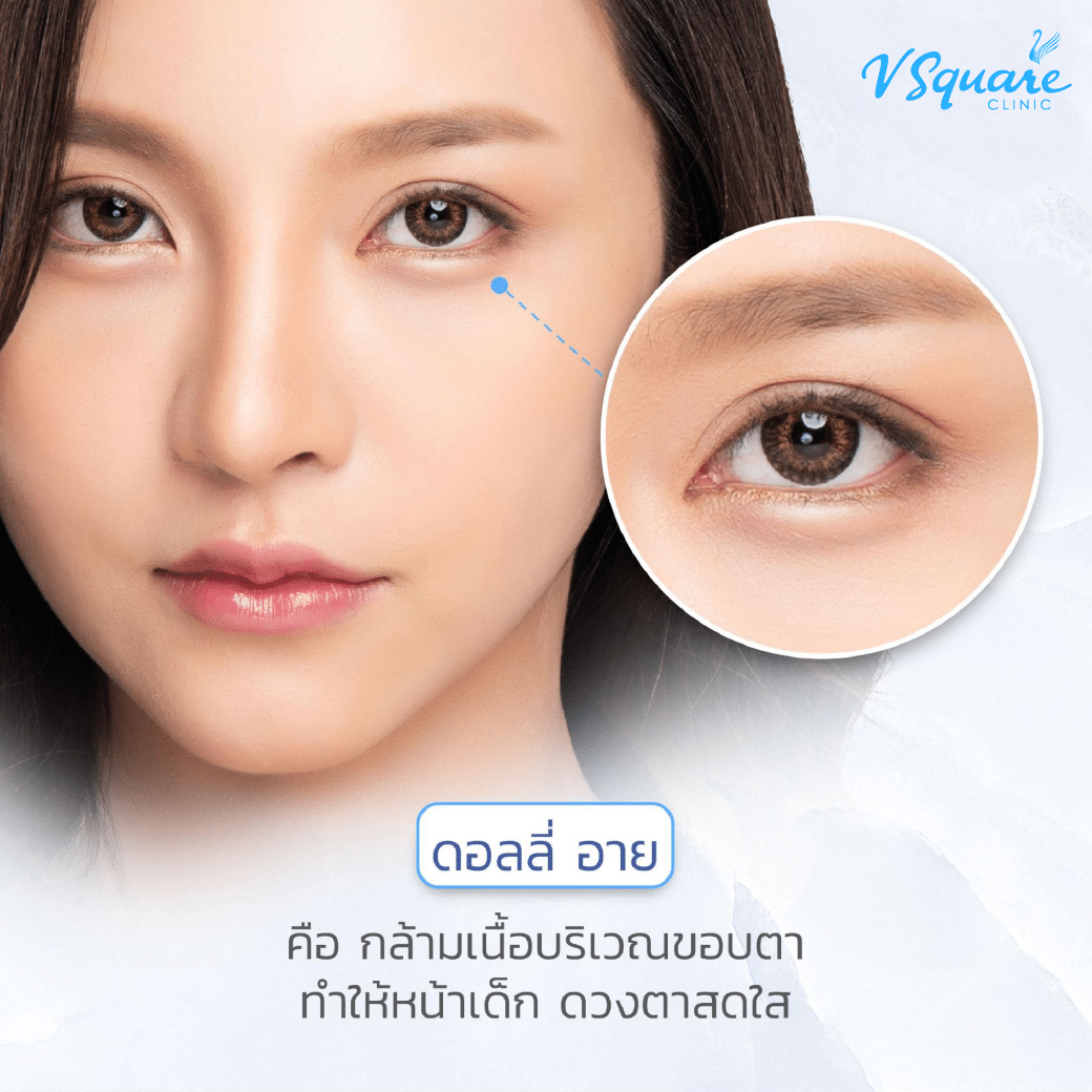 ฉีดฟิลเลอร์ดอลลี่อาย