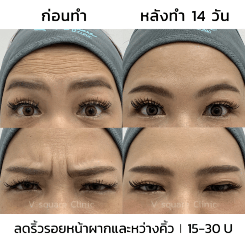 ฉีดโบท็อกตาไม่เท่ากัน_คุณออย