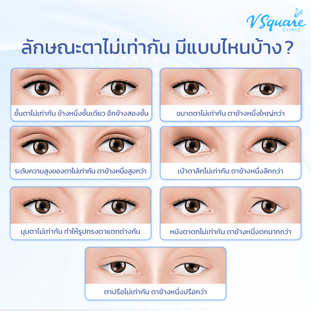 ชั้นตาไม่เท่ากัน