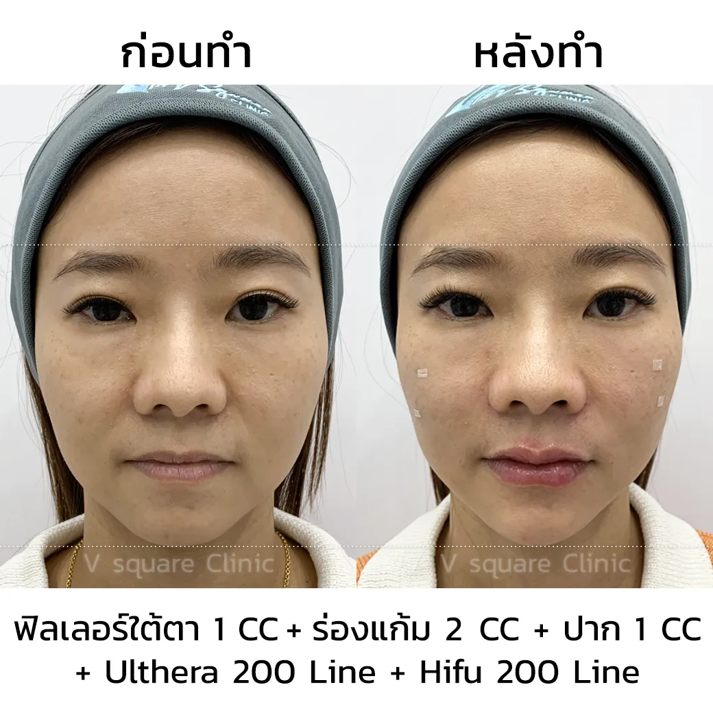 รีวิว Ulthera SPT