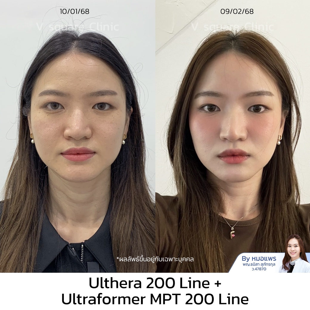 รีวิว Ulthera ฟิว