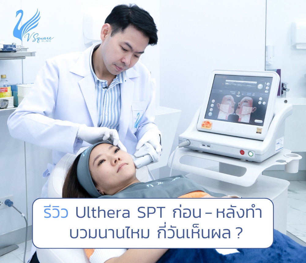 รีวิว Ulthera โดยหมอเบิร์ด